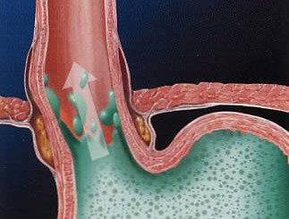 La malattia da reflusso gastro-esofageo